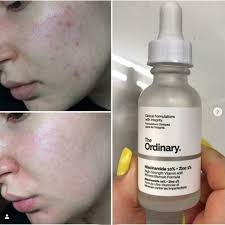 The Ordinary Niacinamide 10% + Zinc 1 % - 30m